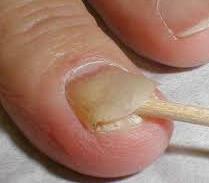 Treating Nail Fungus 2